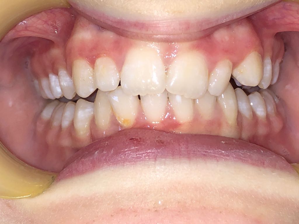 Orthodontics - Upper and lower lip appliances after 5 months - Example 2