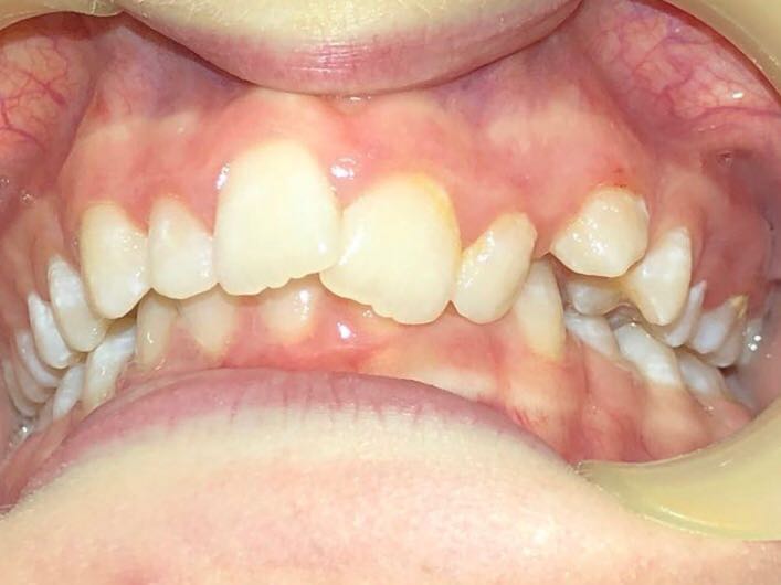 Orthodontics - Upper and lower lip appliances after 5 months - Example 1