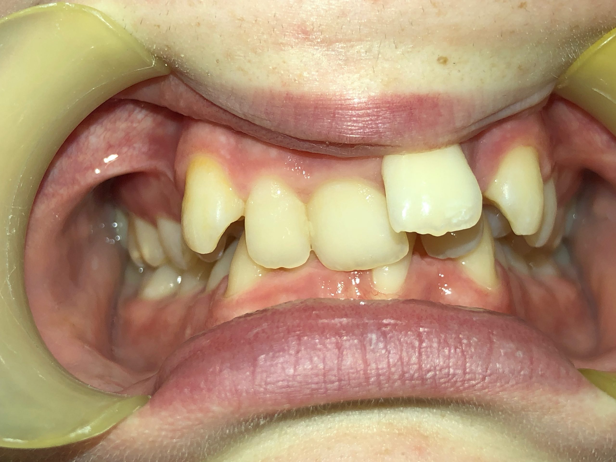 Orthodontics - Upper and lower lip appliances after 5 months - Example 3