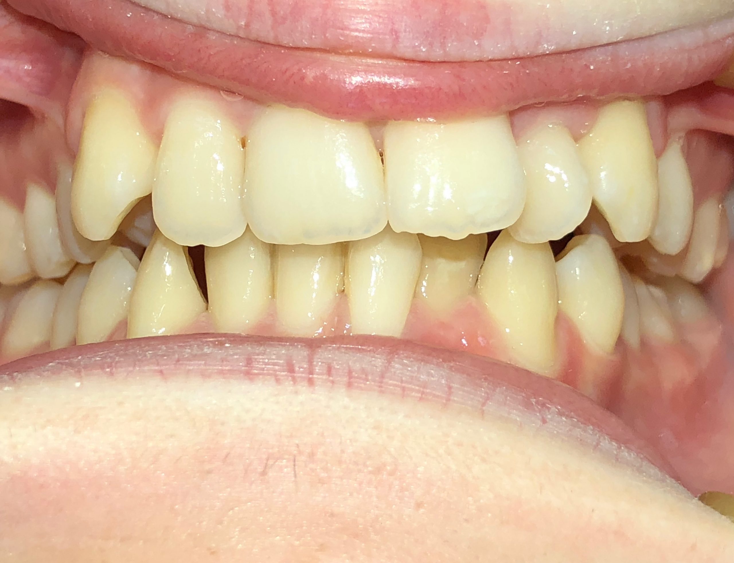 Orthodontics - Upper and lower lip appliances after 5 months - Example 4