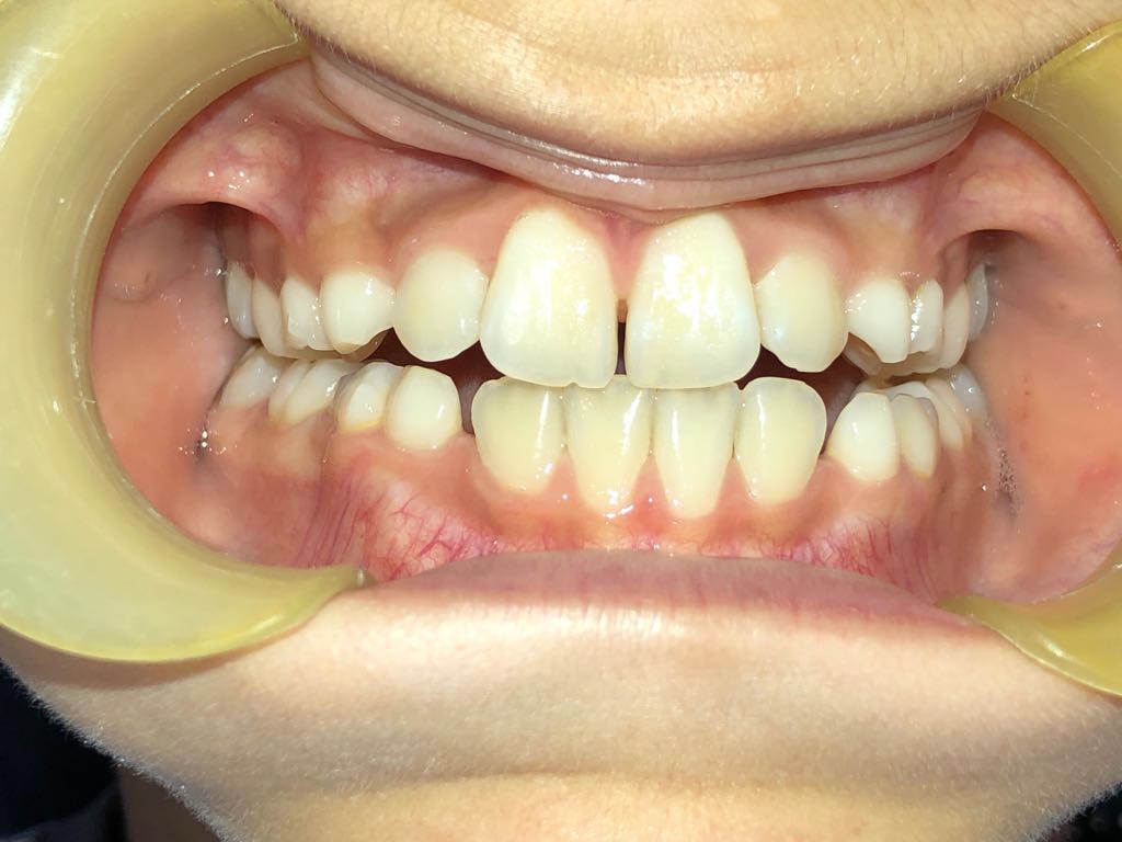 Orthodontics - Upper and lower lip appliances - Example 2