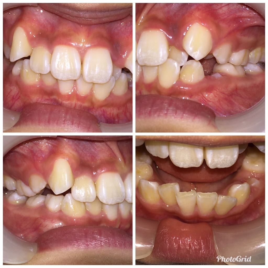 Orthodontics - Upper and lower lip appliances - After - Example 1