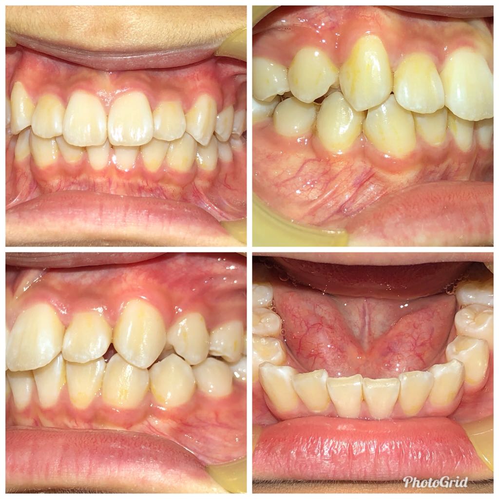 Orthodontics - Upper and lower lip appliances - After - Example 2