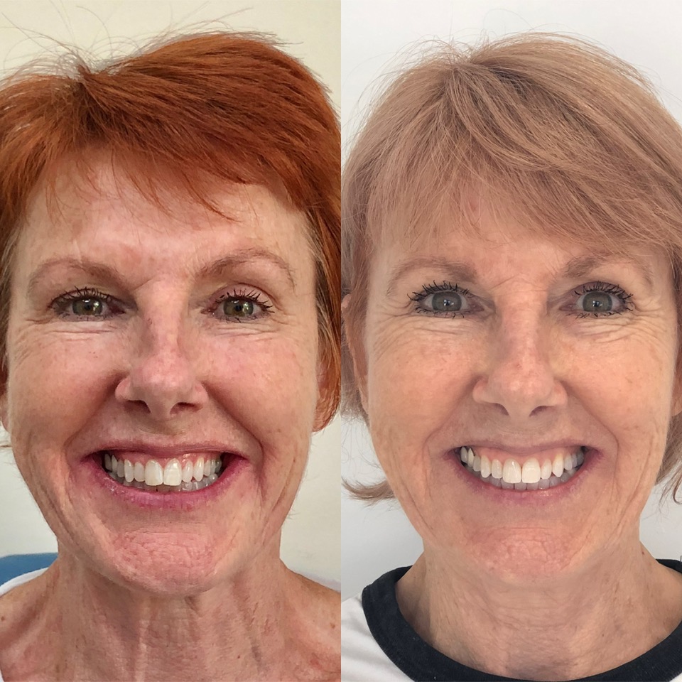 Adult's Orthodontics - Perth Western Australia - Before & After - Eample 2