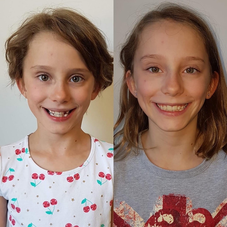 Children's Orthodontics – Before & After - Example 3