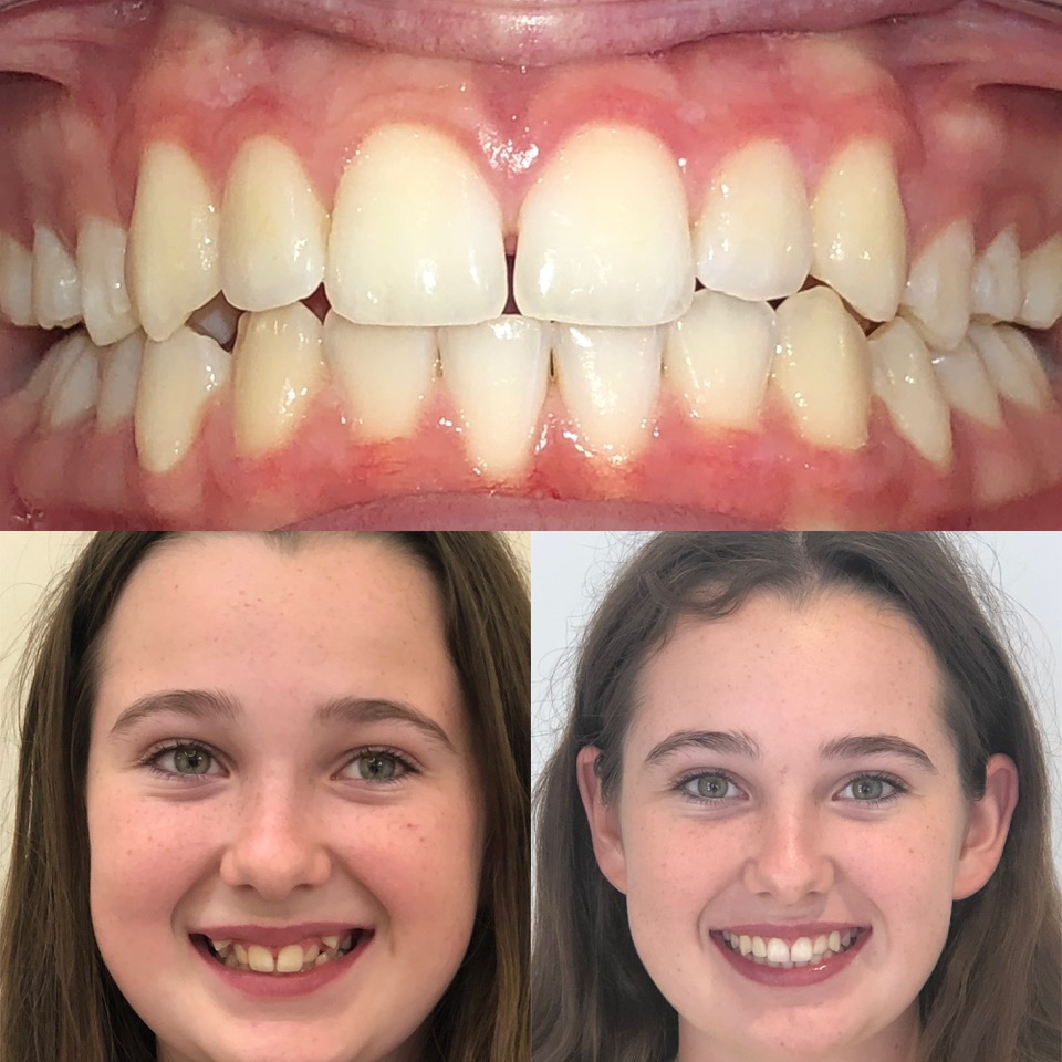 Children's Orthodontics - Teeth - Before & After - Example 1