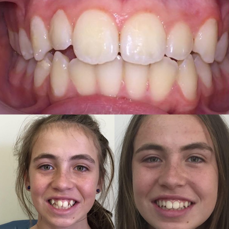 Children's Orthodontics - Teeth - Before & After - Example 2