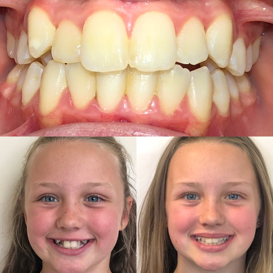 Children's Orthodontics - Teeth - Before & After - Example 3