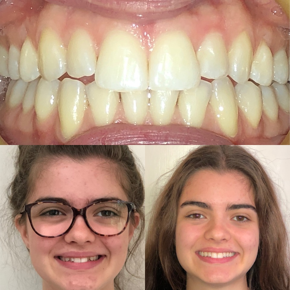 Children's Orthodontics - Teeth - Before & After - Example 4