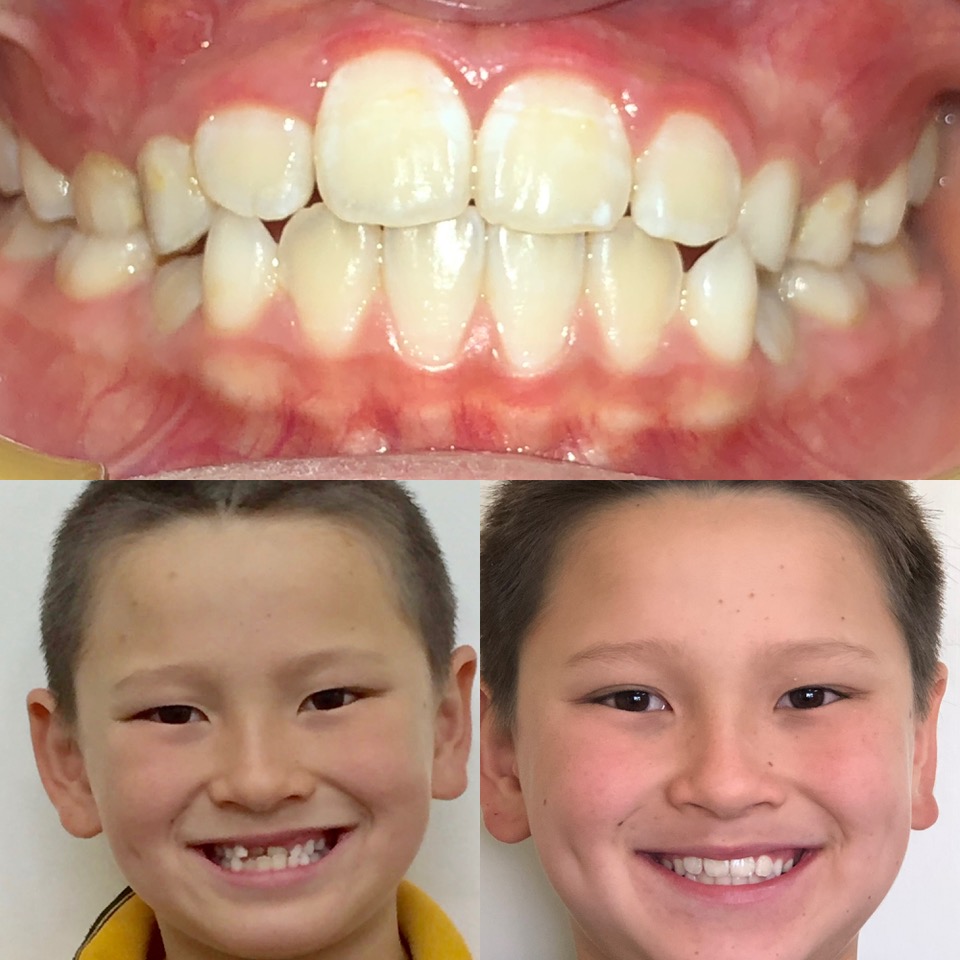 Children's Orthodontics - Teeth - Before & After - Example 5