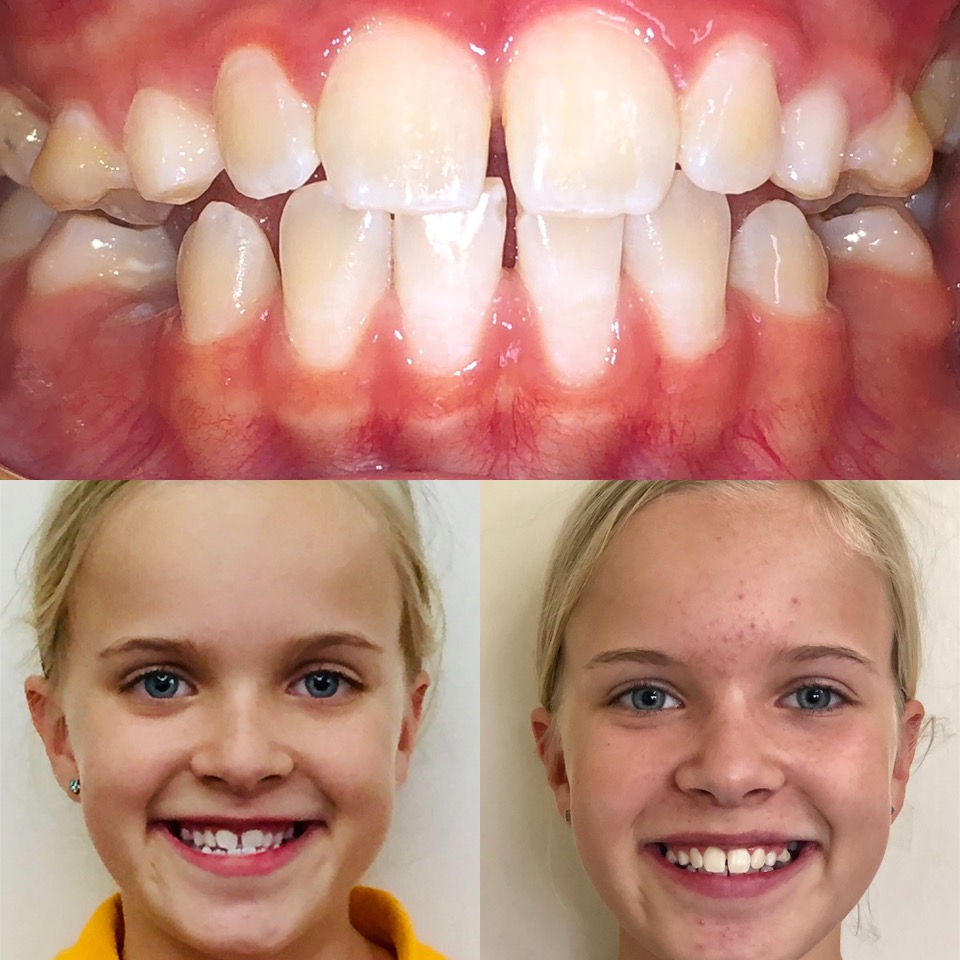 Extraction-Free Non-Fixed Orthodontics - Example 1