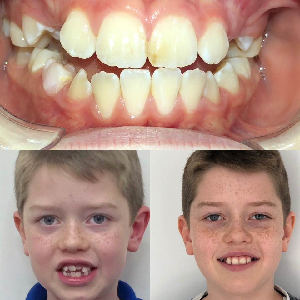 Extraction-Free Non-Fixed Orthodontics - Example 2